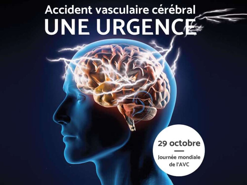 Révolution en neurologie : La France transforme la prise en charge de l'AVC