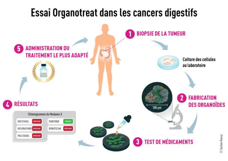 Cancer colorectal : les organoïdes peuvent-ils sauver les patients ?