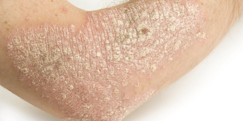 L’impact majeur du psoriasis sur l’intimité