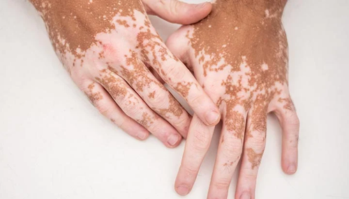 Incyte annonce l’approbation de la crème Opzelura® (ruxolitinib) pour le traitement du vitiligo non segmentaire par la Commission européenne